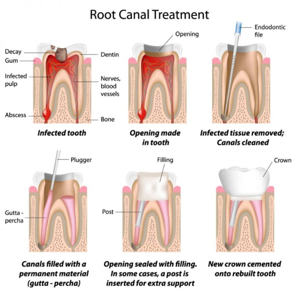 root canal